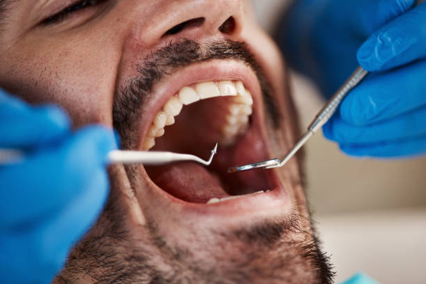 Best Emergency Gum Treatment in Lake Secession, SC