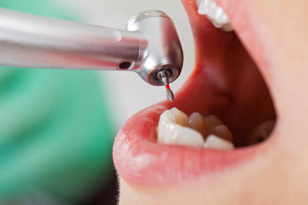 Best Emergency Dental Care for Broken or Chipped Teeth in Lake Secession, SC